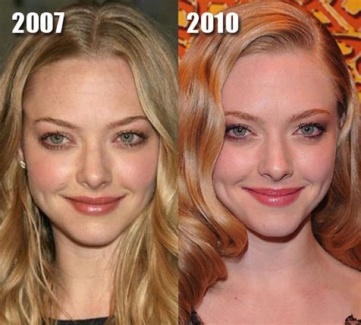 Amanda Seyfried Plastic Surgery Before and After
