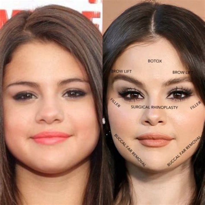 Selena Gomez Plastic Surgery Before and After